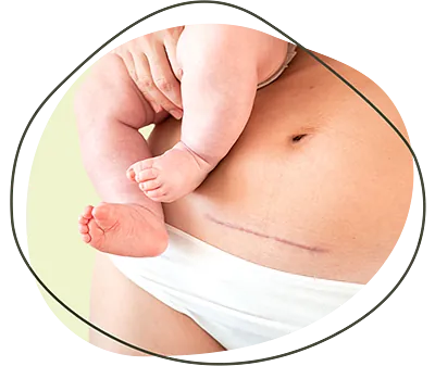 Frau mit Kaiserschnittsnarbe hält ein Baby